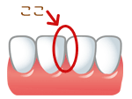 歯と歯の間